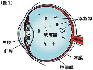眼前有黑點飄，視物有些變形是什么眼病